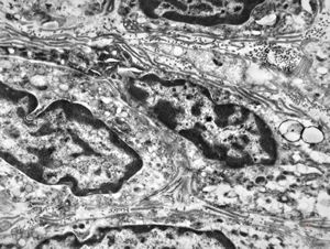 F,41y. | synovial metaplasia - capsule of implantate